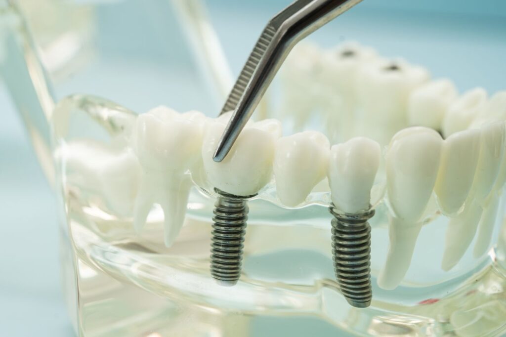 temporary bridge | dental implants in turkey