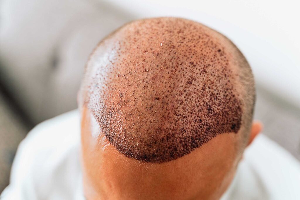 man getting hair transplant in Turkey