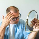 a man before hair transplant in Turkey