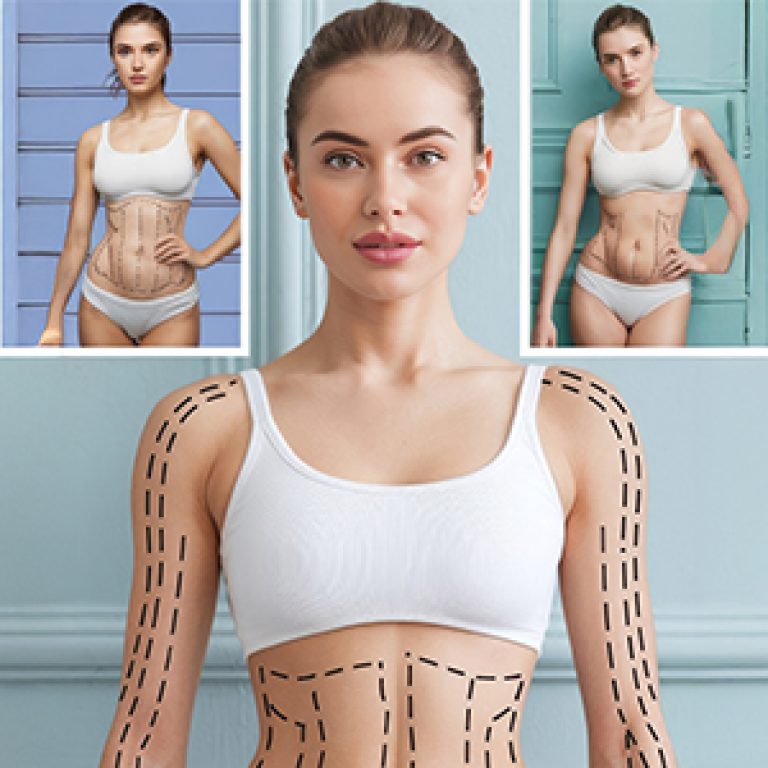 body contouring surgery