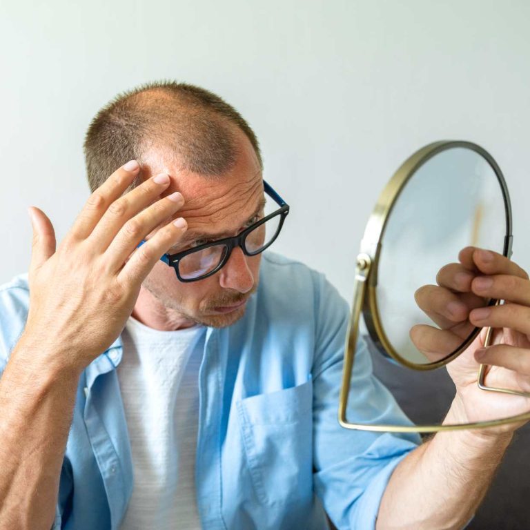 a man before hair transplant in Turkey